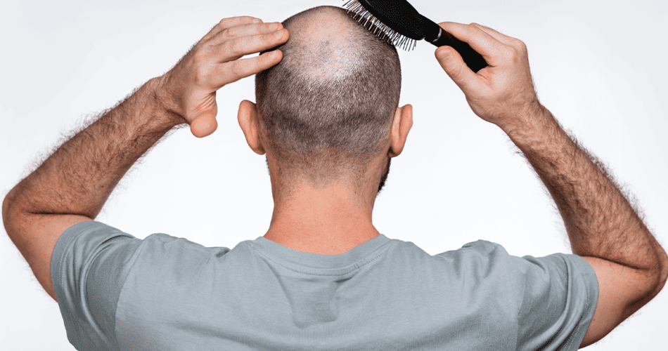 Qual o melhor tratamento para combater a alopecia androgenética – a popular “calvície hereditária”?